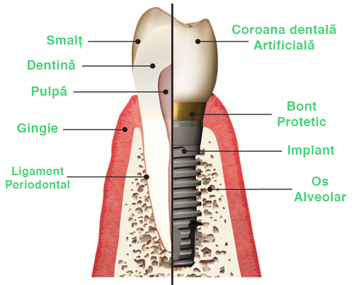 Implant Dentar TEODENTAL