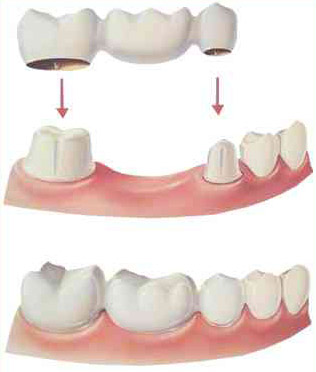 pretetica-punti-dentare